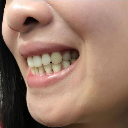 牙齿矫正前后对比照真实过程分享终于不是龅牙妹了哦