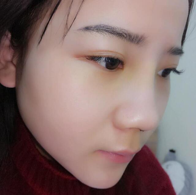 隆鼻整形前后恢复过程隆鼻梁+垫鼻尖整形果很好哦