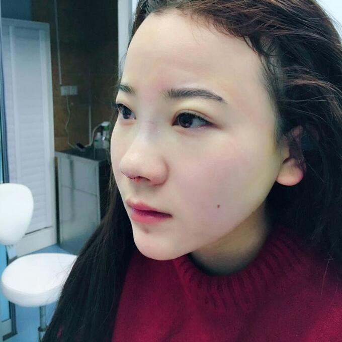 隆鼻整形前后恢复过程隆鼻梁+垫鼻尖整形果很好哦