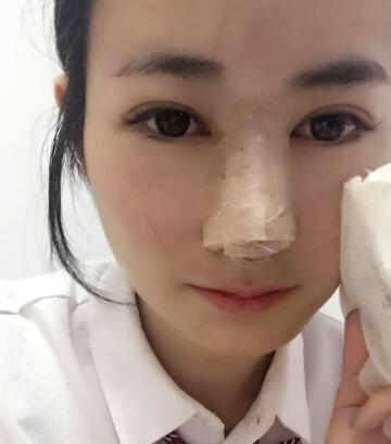 假体隆鼻+鼻翼缩小第4-5天的图片
