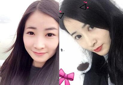隆鼻前后的对比照片