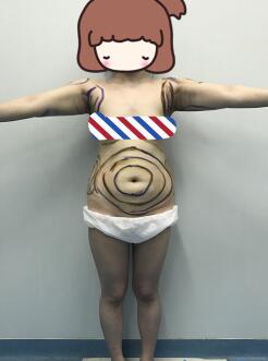 吸脂减肥前照片
