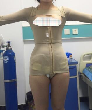 水动力吸脂减肥手术后在医院拍的照片