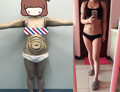 吸脂减肥瘦腰腹+手臂术后果对比图