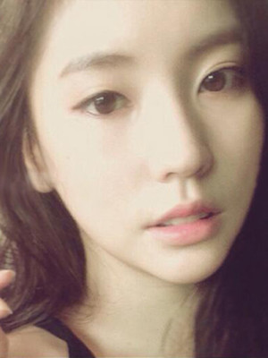 埋埋蛋白线.提升术后恢复记录分享还有对比照