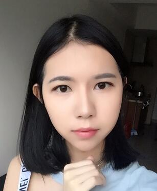 自体脂肪填充恢复日志 自体脂肪填充太阳穴+额头