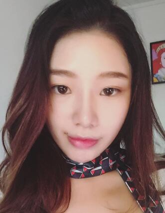 硅胶隆鼻恢复日记 硅胶隆鼻+鼻小柱延长+垫鼻尖