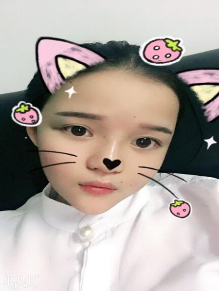 我的硅胶隆鼻+自体脂肪丰下巴+自体脂肪丰太阳穴恢复果案例日记