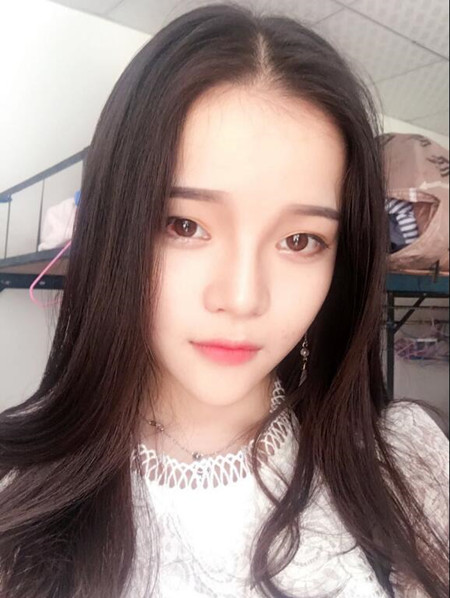 我的硅胶隆鼻+自体脂肪丰下巴+自体脂肪丰太阳穴恢复果案例日记