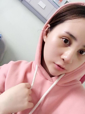 我的膨体隆鼻+双眼皮手术让我的颜值蹭蹭上升 内有恢复果对比图哦