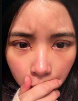 单眼皮割双眼皮果+开眼角前后对比照片图