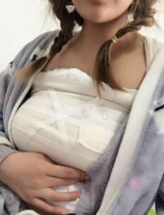 曼托假体隆胸手术后第五天