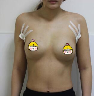 隆胸手术后一周