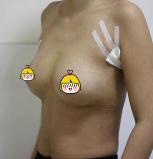 假体隆胸手术后侧面照