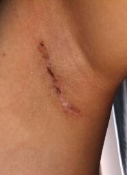 腋下伤口结疤了