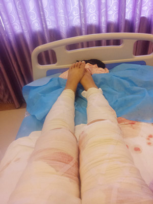 水动力吸脂瘦大腿后瘦了不止一点点