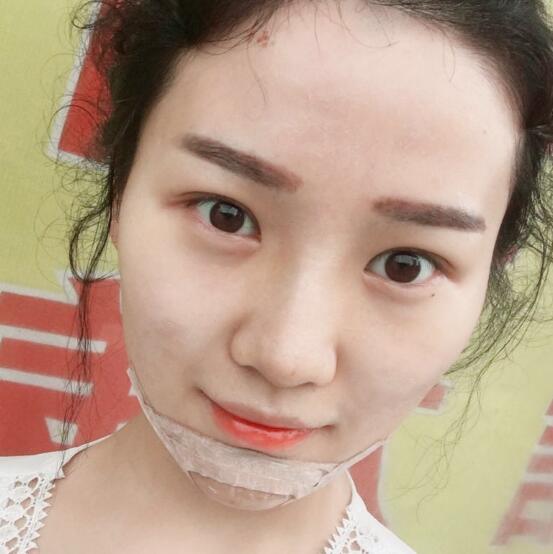 玻尿酸垫下巴手术恢复全过程图片分享