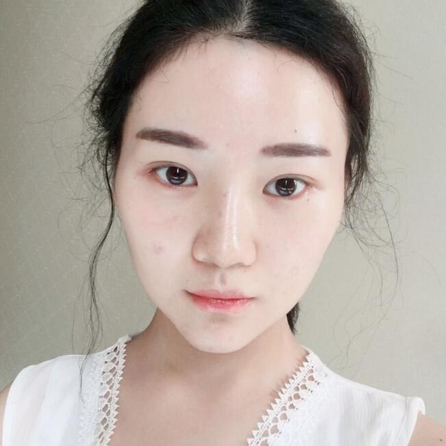 玻尿酸垫下巴手术恢复全过程图片分享