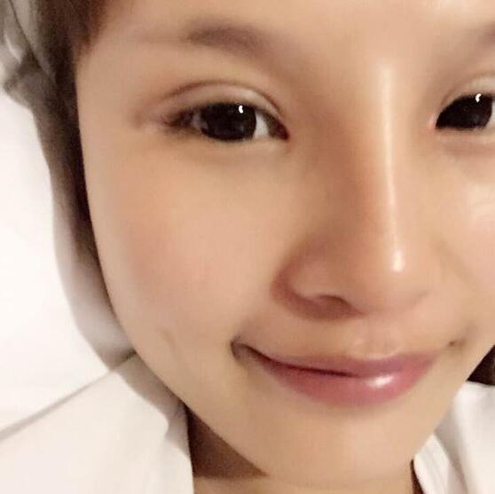 自体脂肪隆鼻+割双眼皮的恢复过程让我找到了自信