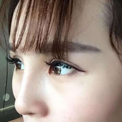 自体脂肪隆鼻+割双眼皮的恢复过程让我找到了自信