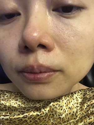 做了高强度聚焦超声，果还不错，想把经历分享给大家