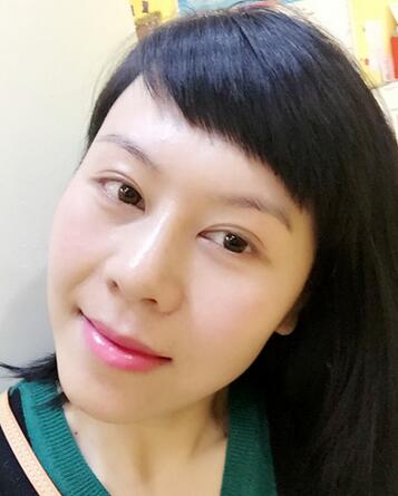 面部埋埋蛋白线.提升恢复过程分享