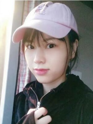 隆鼻整形真实恢复期图片，大鼻子终于变秀气了