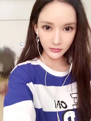 面部埋埋蛋白线.提升术后照片，皮肤紧致不少了