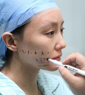 面部埋埋蛋白线.提升手术过程分享