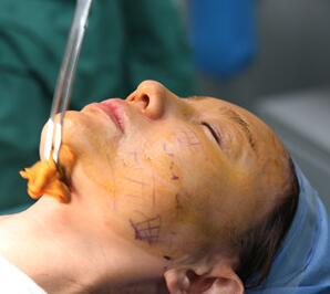 面部埋埋蛋白线.提升手术