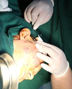 面部埋埋蛋白线.提升手术