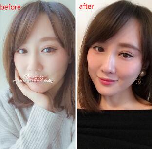 面部埋埋蛋白线.提升手术