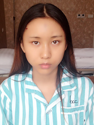 自体脂肪填充面部多图分享还有术后小贴士哦