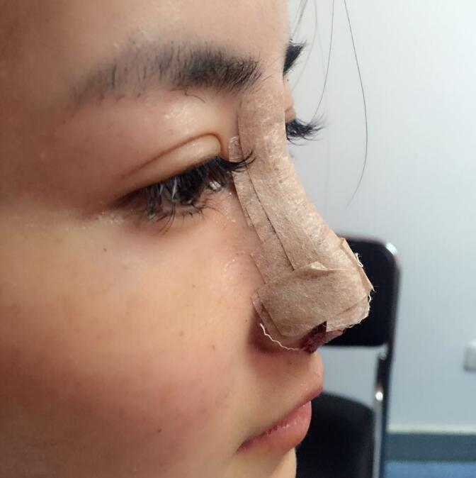 隆鼻整形鼻翼缩小+假体隆鼻术后恢复过程分享