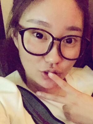 双眼皮失败修复手术恢复前后对比图