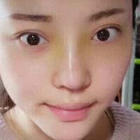 假体隆鼻15天后恢复图，隆鼻果自然