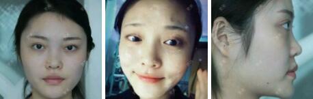 假体隆鼻15天后恢复图，隆鼻果自然