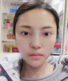 假体隆鼻15天后恢复图，隆鼻果自然