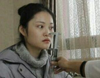 假体隆鼻15天后恢复图，隆鼻果自然