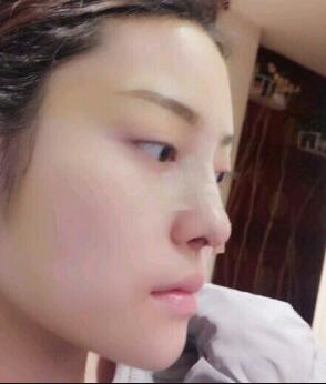 假体隆鼻15天后恢复图，隆鼻果自然