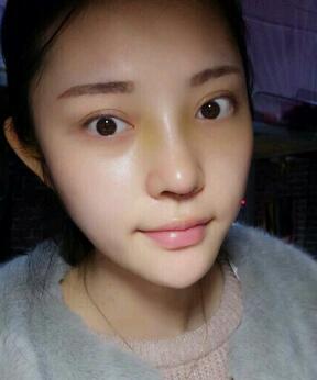 假体隆鼻15天后恢复图，隆鼻果自然