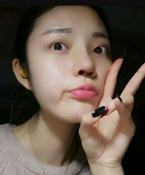 假体隆鼻15天后恢复图，隆鼻果自然