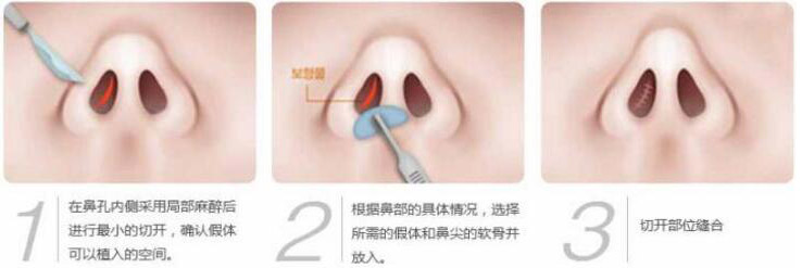 硅胶假体隆鼻过程和隆鼻前后图片，真实案例分享