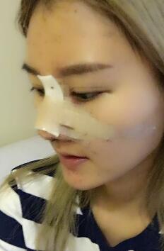 硅胶假体隆鼻过程和隆鼻前后图片，真实案例分享