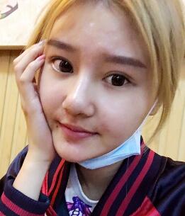 硅胶假体隆鼻过程和隆鼻前后图片，真实案例分享