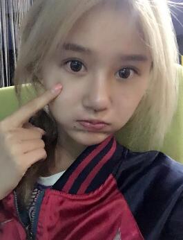 硅胶假体隆鼻过程和隆鼻前后图片，真实案例分享