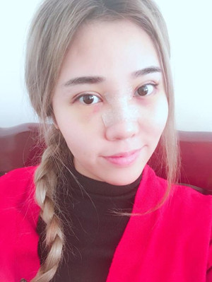 长沙华韩华美做的隆鼻整形，感觉果还不错哦!