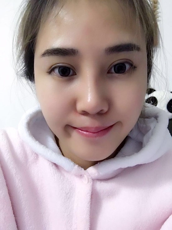 长沙华韩华美做的隆鼻整形，感觉果还不错哦!