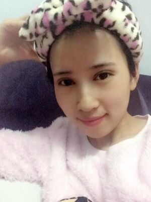 切开双眼皮恢复过程，手术很成功哦