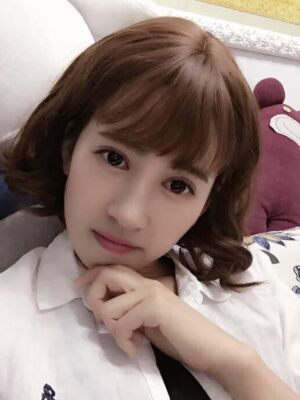 切开双眼皮恢复过程，手术很成功哦